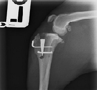 Cruciate surgery x-ray