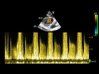 A colour Doppler ultrasound showing a ventricular septal defect