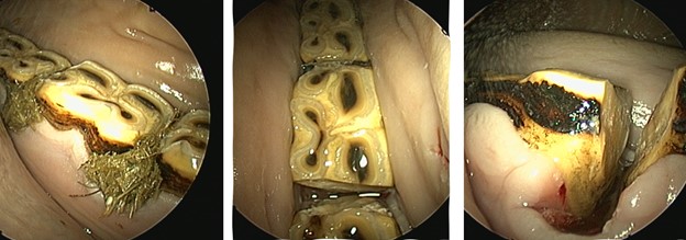 Diastema widening