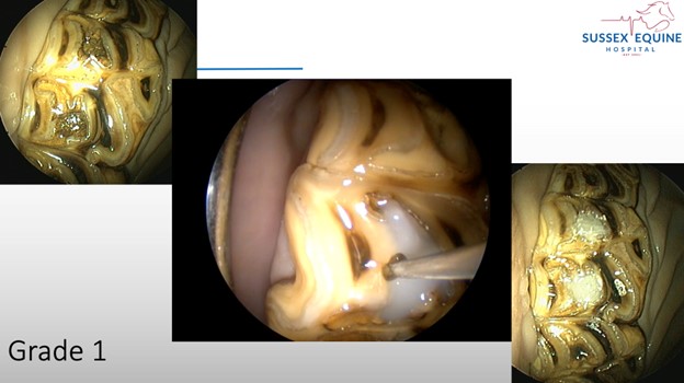 Infundibular restorations