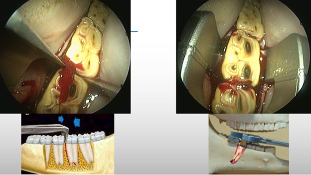 Oral extraction