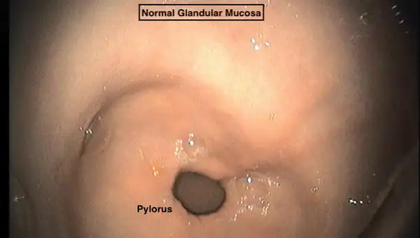 Gastrology Figure 2 Glandular mucosa pylorus